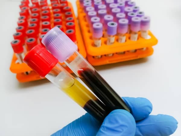 Blood Test Measuring Biological Age May Reveal Dementia Risk